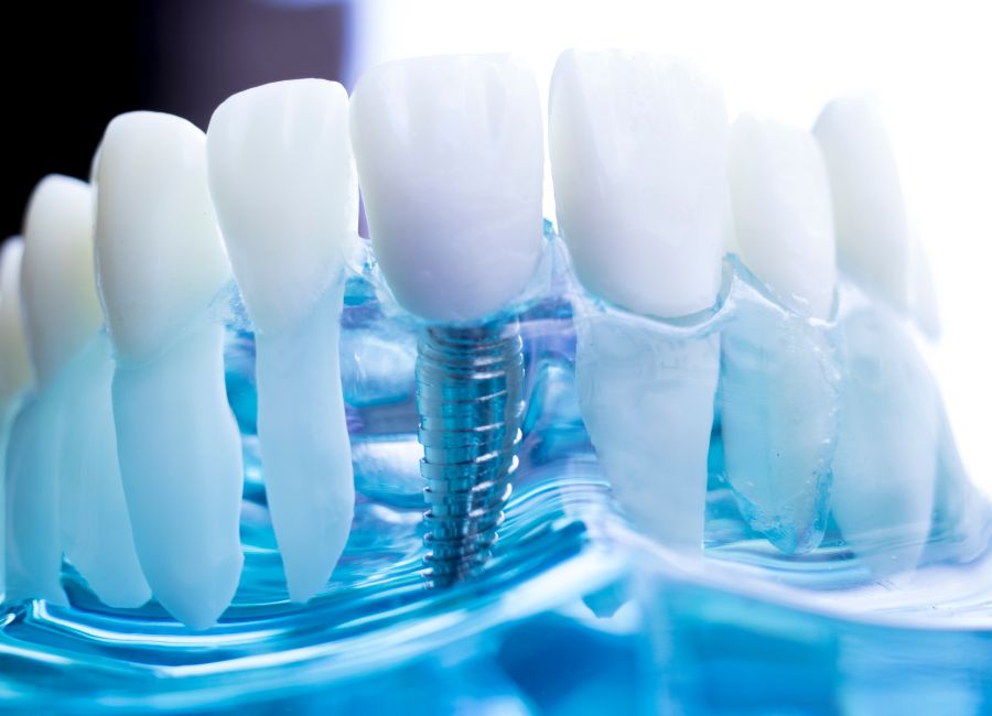 Tutto Quello Che Devi Sapere Sull’Implantologia Dentale